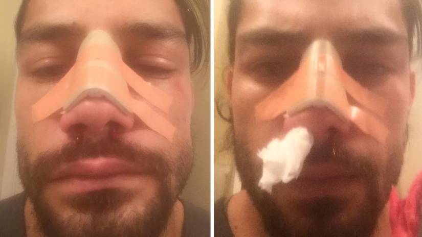 roman reigns nose job Image 5
