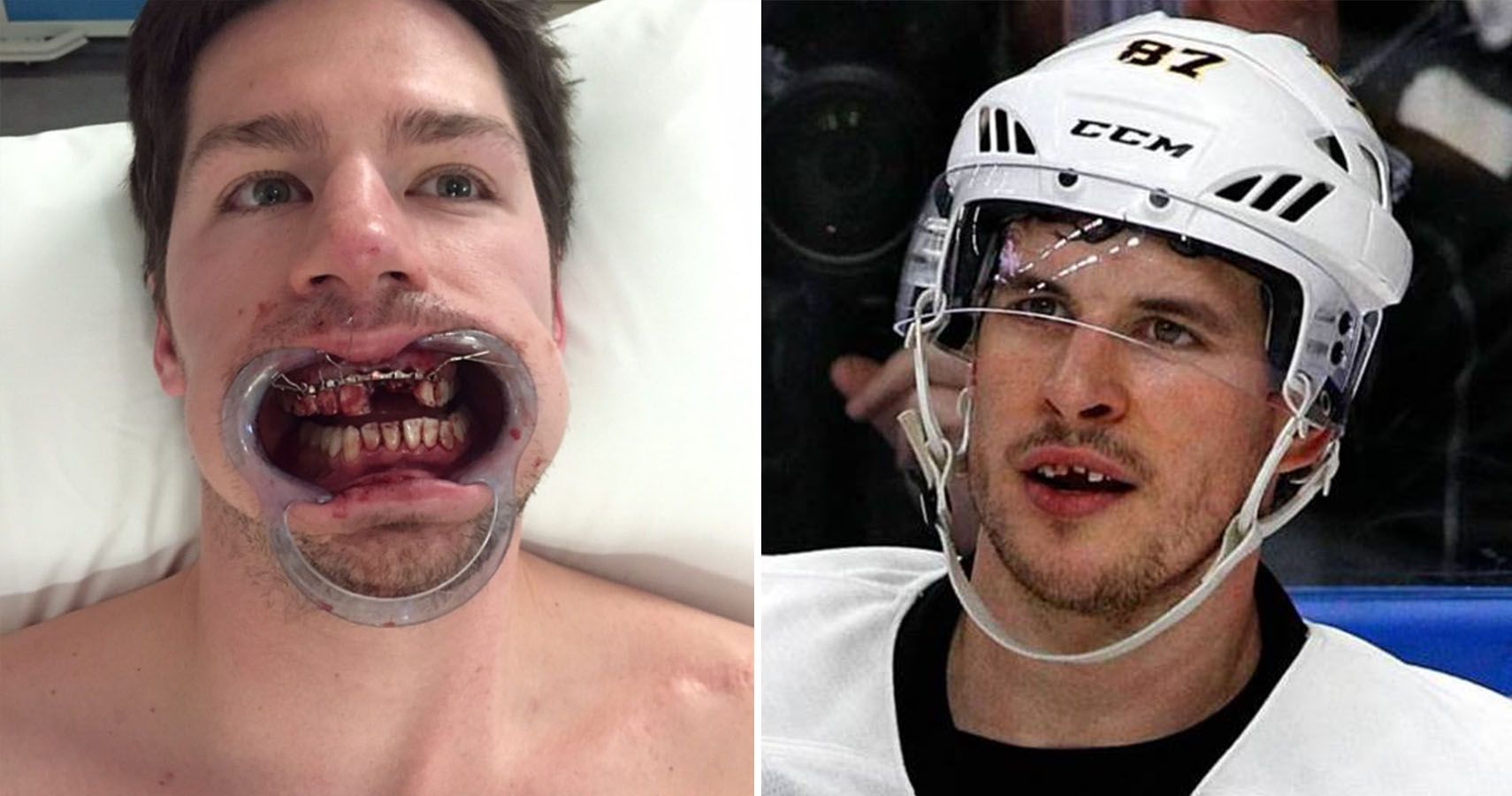 Hockey player's teeth come flying out after he takes is struck in