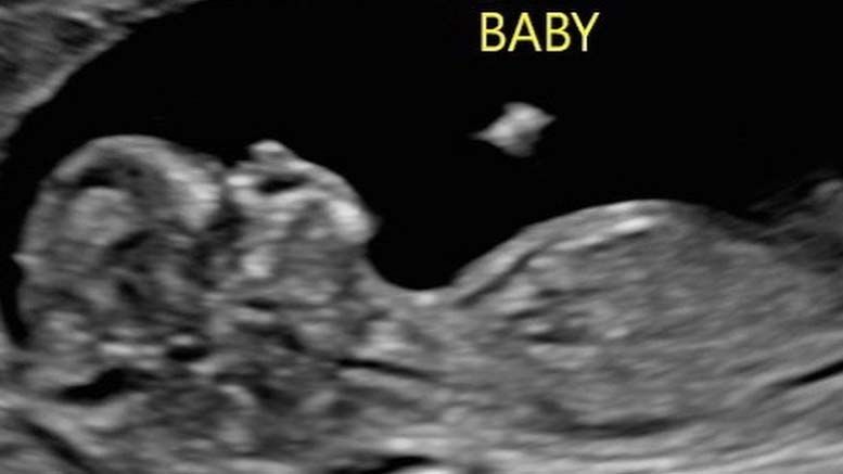 becky lynch seth rollins birthday ultrasound image baby child pregnant