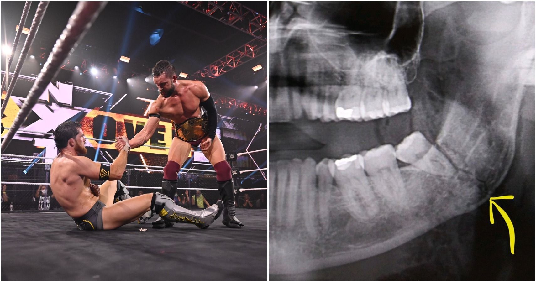 Finn Balor Reveals Serious Injury To His Jaw