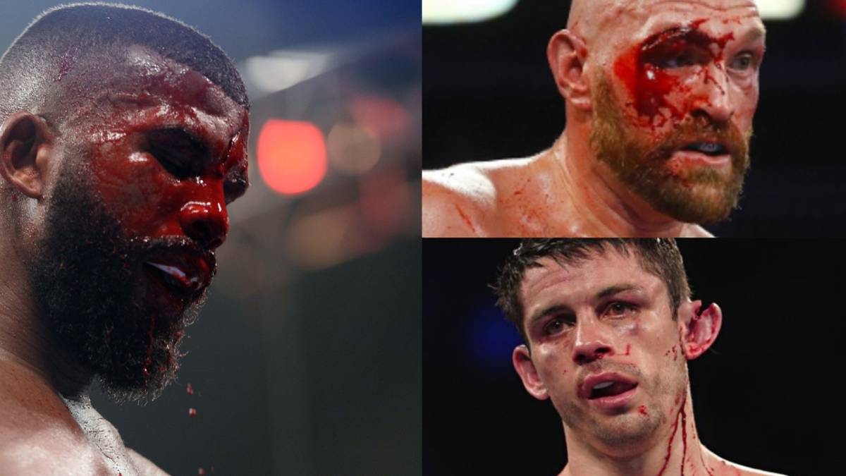 Sport Injuries Boxing 13 Worst Looking Injuries In Boxing History